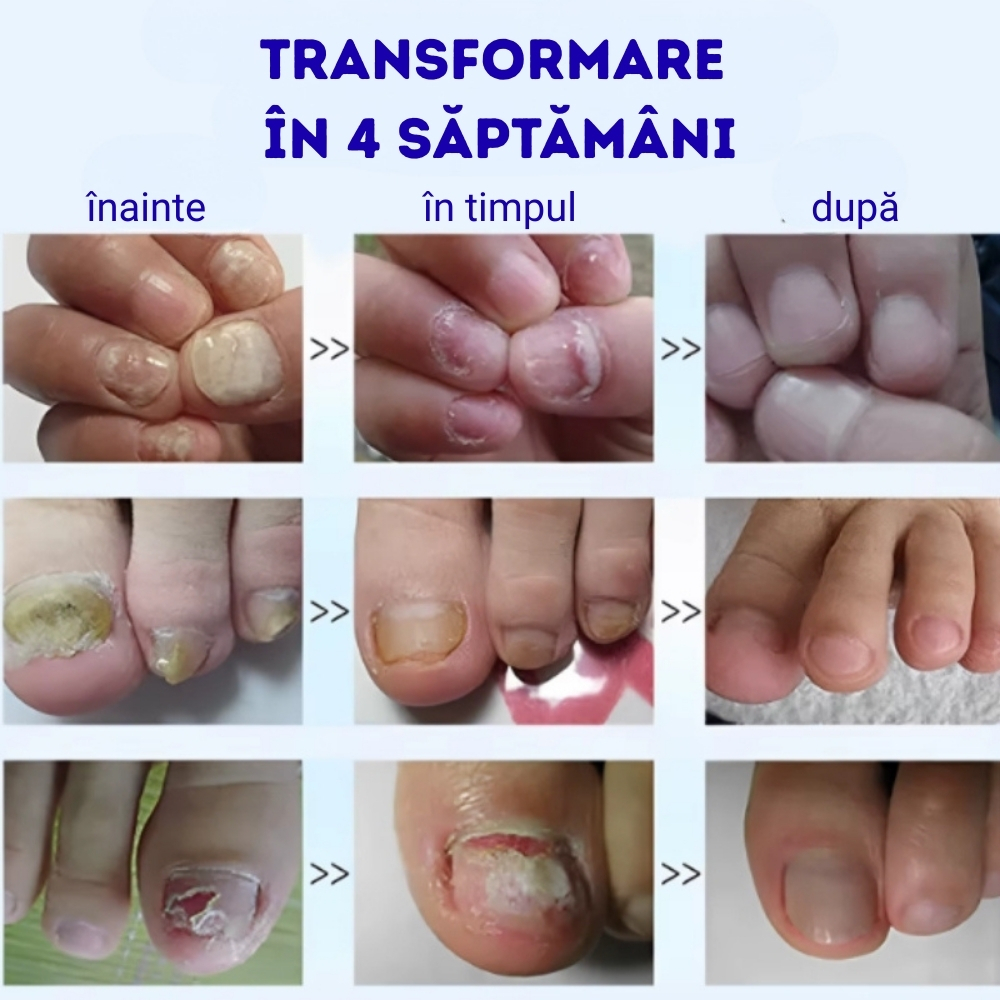 Soluție naturală SEFUDUN® pentru tratarea ciupercii unghiei, sinergie de uleiuri esențiale și glicerină,10 ml - imagine 4