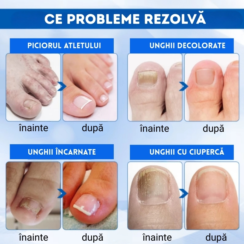 Ulei Tratament Unghii Încarnate și Anti-Paronichie SEFUDUN®– Dezinfectează, Ameliorează Durerea, Înmoaie și Reface Unghia Natural, 30ml - imagine 6